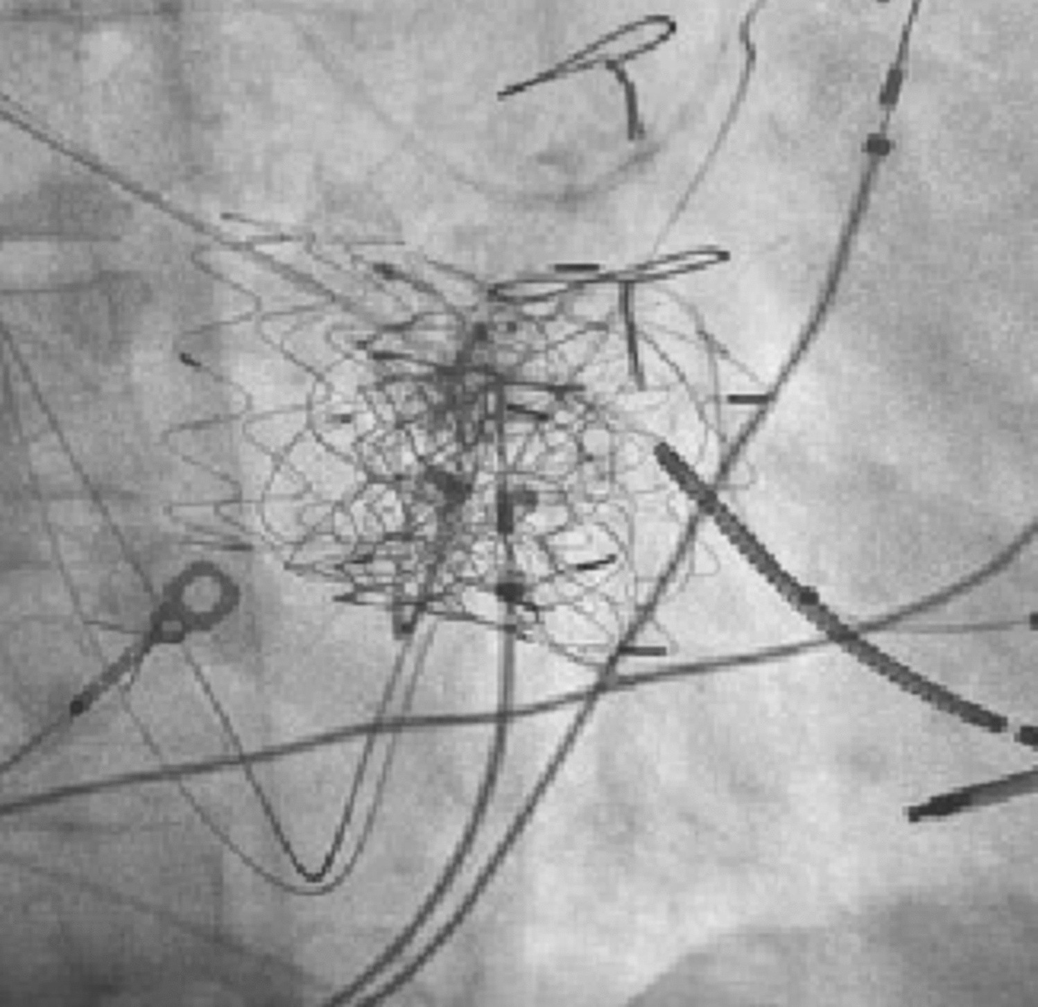 Pacing and Defibrillation Consideration in the Era of Transcatheter Tricuspid Valve Replacement