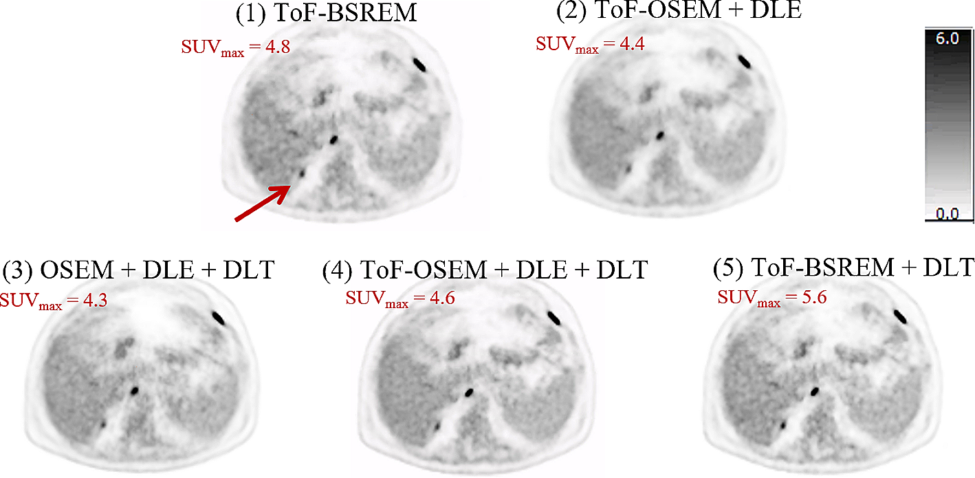 Sequential deep learning image enhancement models improve diagnostic confidence, lesion detectability, and image reconstruction time in PET