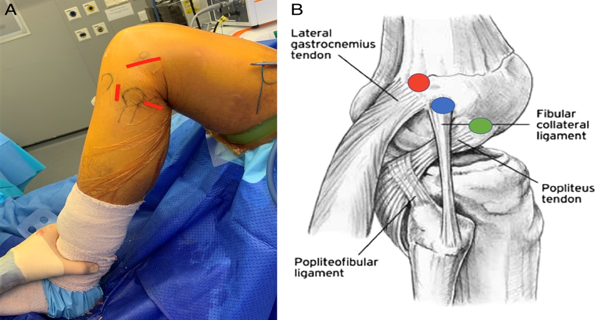A 3-incision Minimally Invasive Approach For Posterolateral Corner Reconstruction With Combined Lateral Extra-articular Tenodesis For Lateral Knee Ligament Instability