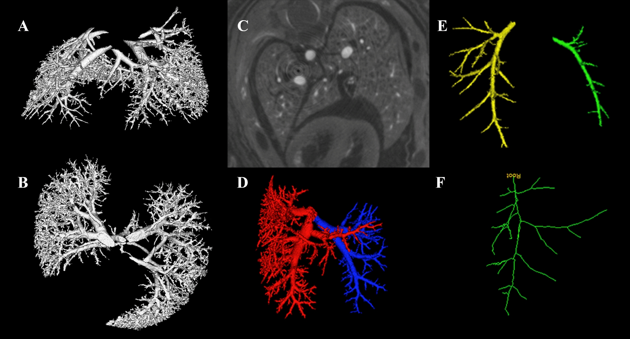 Pulmonary vasculature development in congenital diaphragmatic hernia: a novel automated quantitative imaging analysis