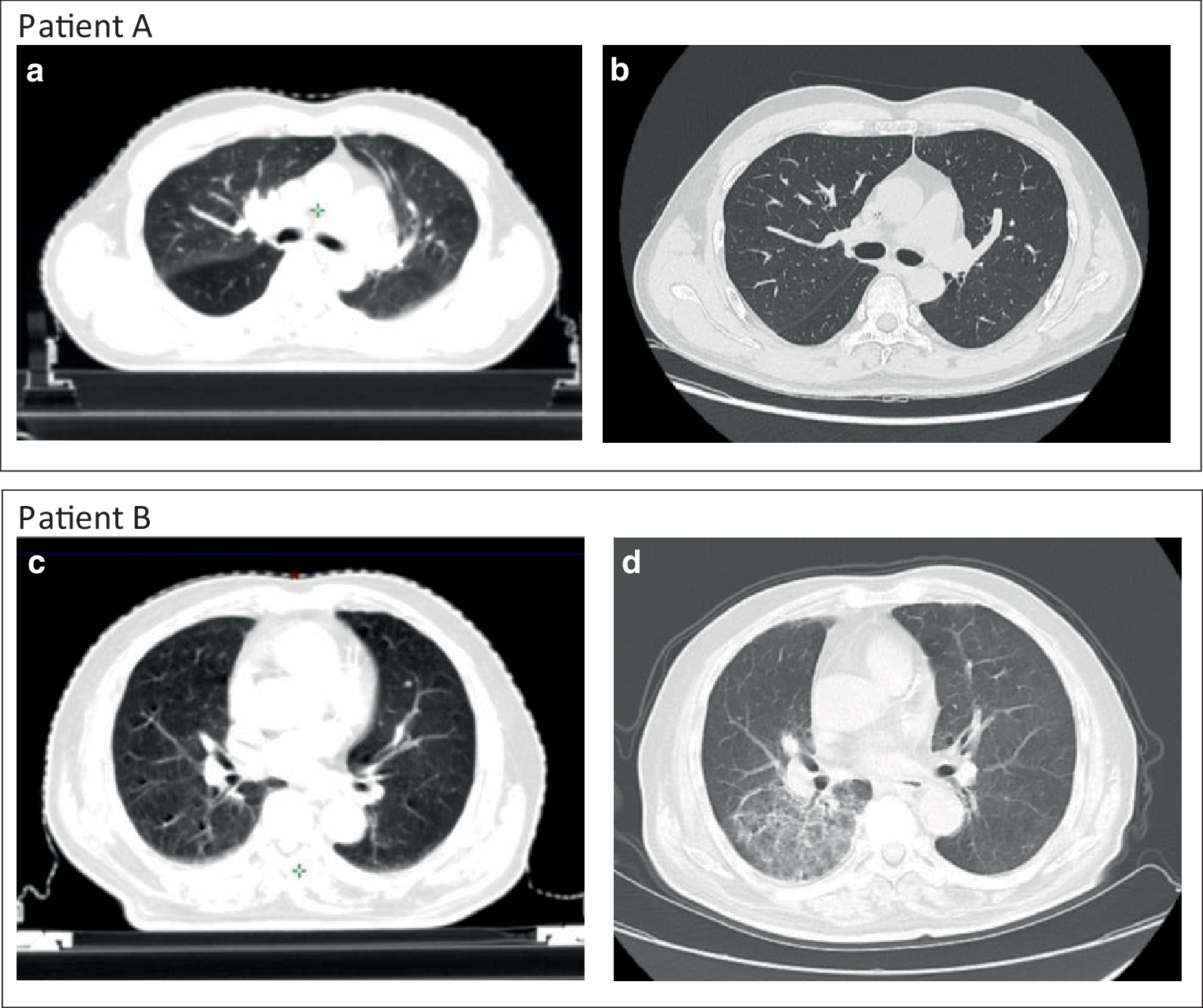 Enhancing the prediction of symptomatic radiation pneumonitis for locally advanced non-small-cell lung cancer by combining 3D deep learning-derived imaging features with dose–volume metrics: a two-center study