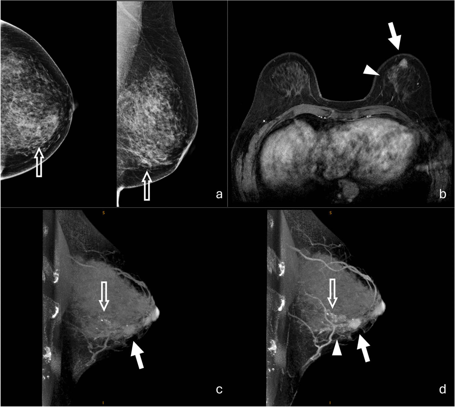 Emerging Clinical Applications for Cone Beam Breast CT: Changing the Breast Imaging Paradigm
