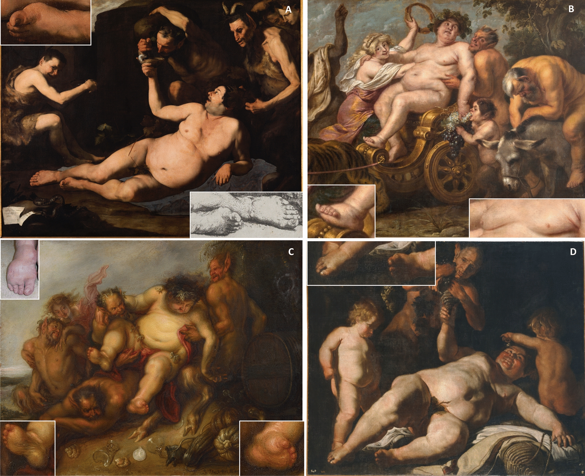 Exposure to alcohol or lead? Chronic gout in baroque depictions of obese Silenus and Bacchus