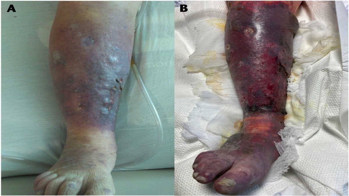 A Case Report of an Uncommon Presentation of Purpura Fulminans With Staphylococcus aureus Endocarditis