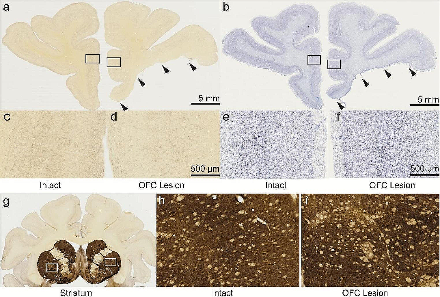 Aspiration removal of orbitofrontal cortex disrupts cholinergic fibers of passage to anterior cingulate cortex in rhesus macaques
