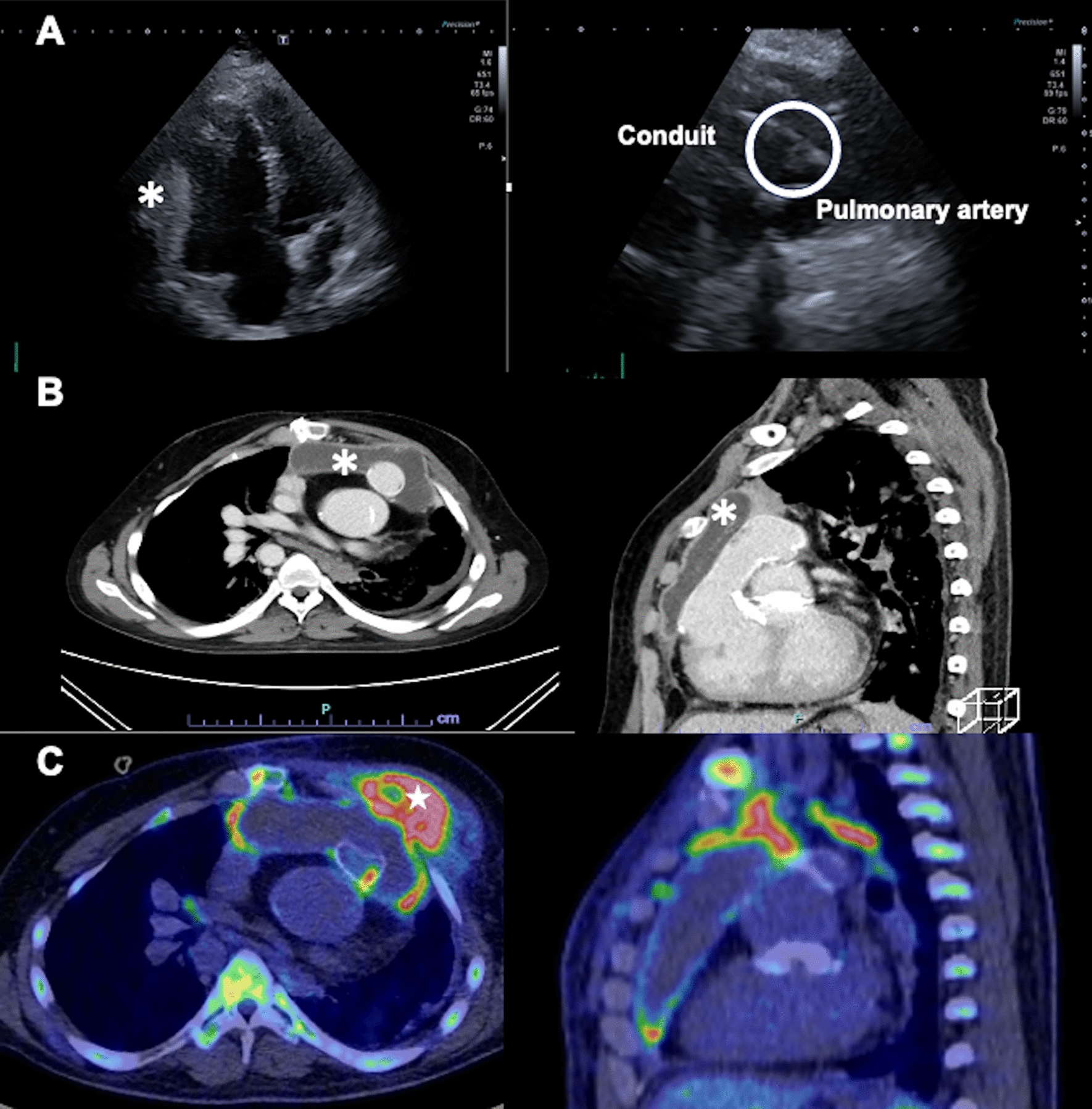 Perforation of the chest wall from bioprosthetic pulmonary valve endocarditis