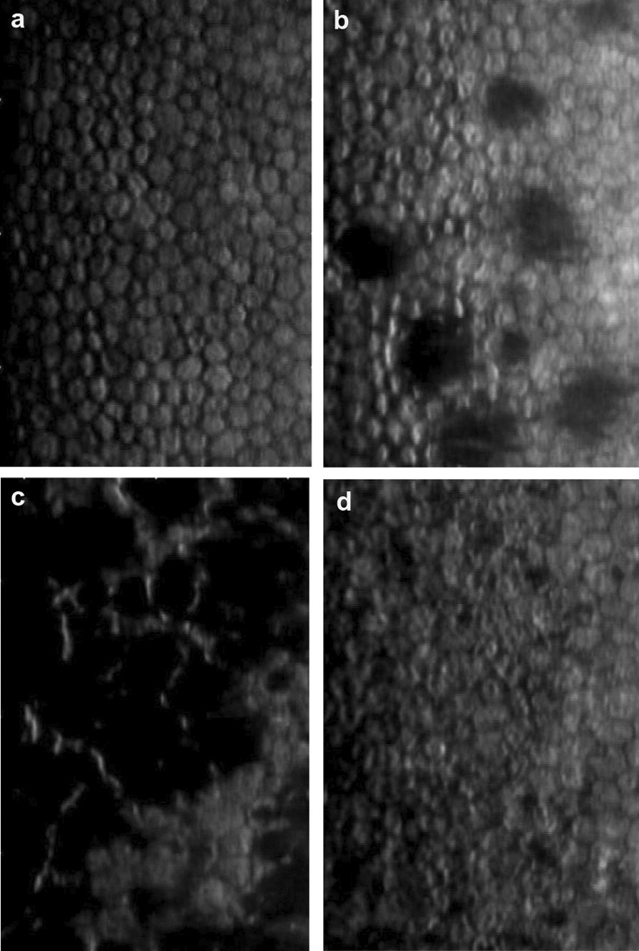 Deep learning for detection of Fuchs endothelial dystrophy from widefield specular microscopy imaging: a pilot study