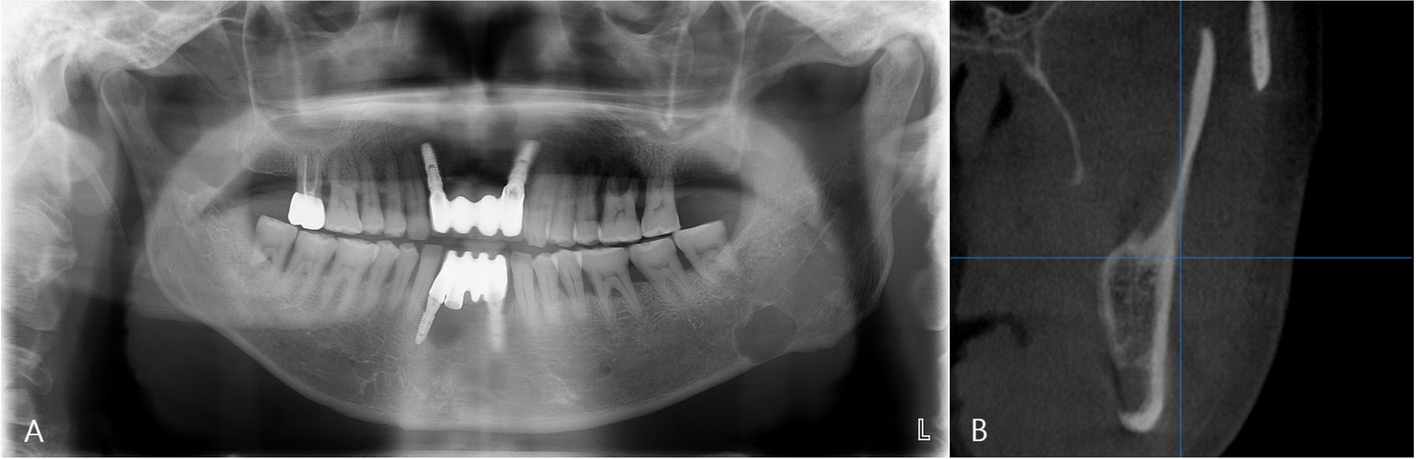 Radiological features of Stafne mandibular bone cavity in panoramic image and cone beam computed tomography
