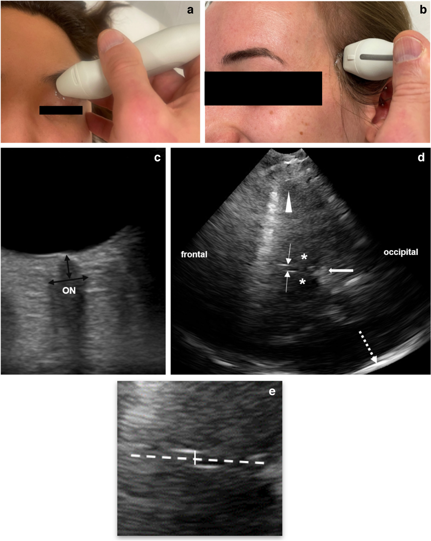 Ultrasound-guided initial diagnosis and follow-up of pediatric idiopathic intracranial hypertension