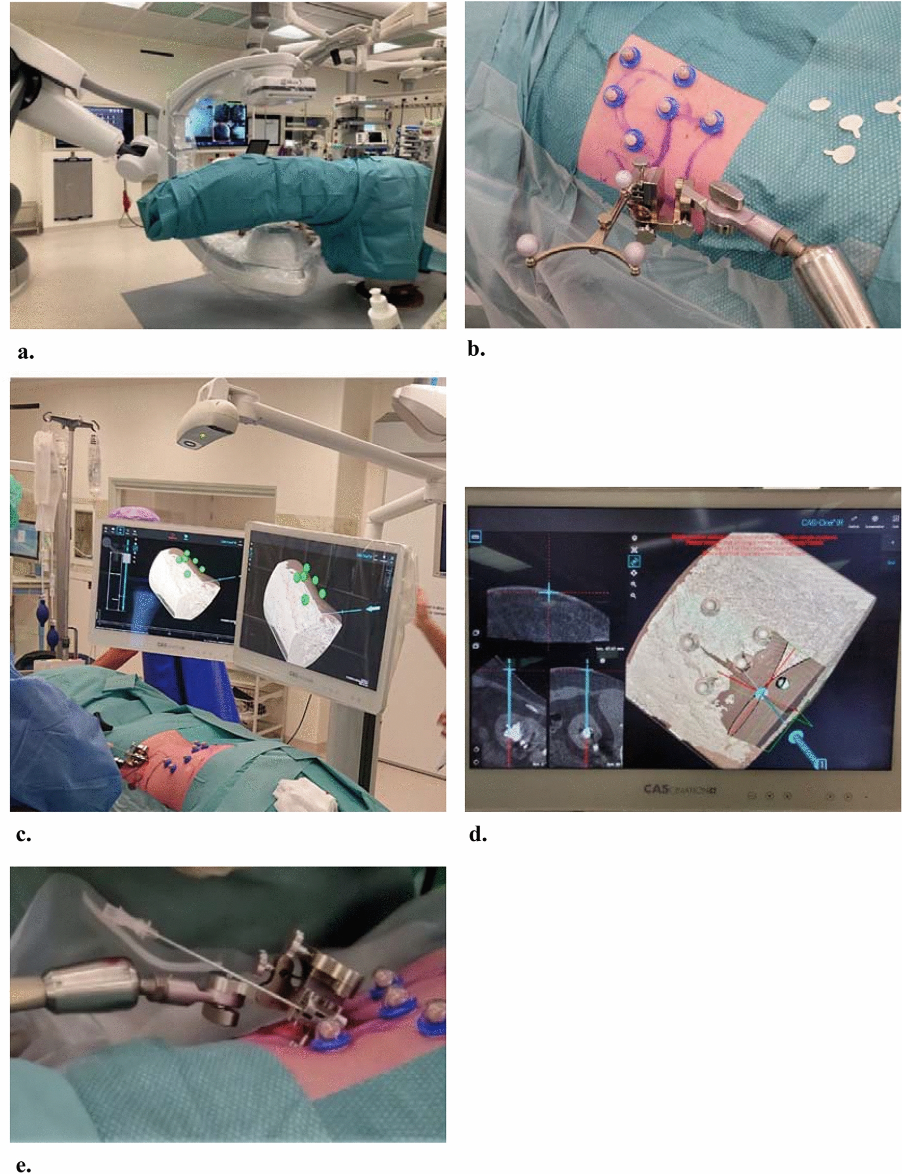 Feasibility of stereotactic optical navigation for needle positioning in percutaneous nephrolithotomy
