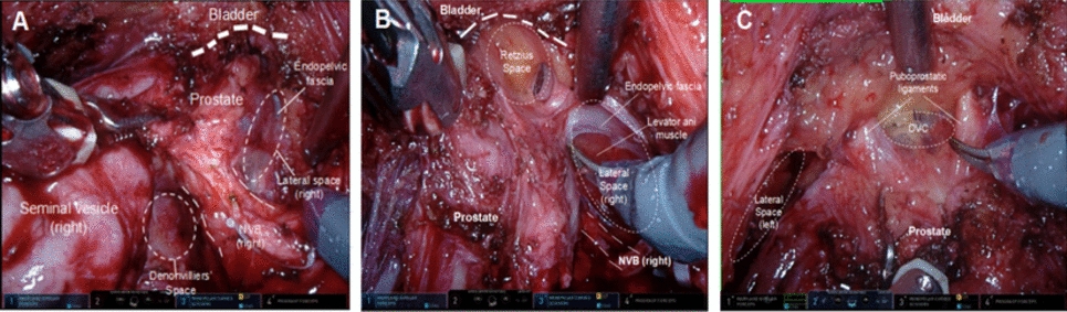 Modified Retzius-sparing robot-assisted radical prostatectomy for cases with anterior tumor: a propensity score-matched analysis