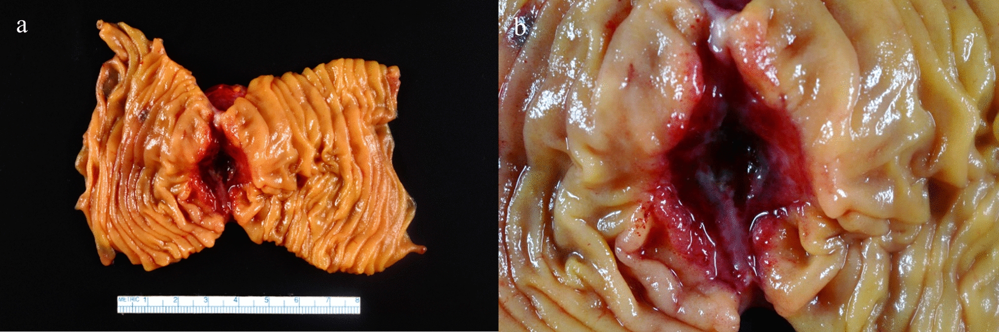 Gastrointestinal histoplasmosis with small intestinal perforation: 20-year experience
