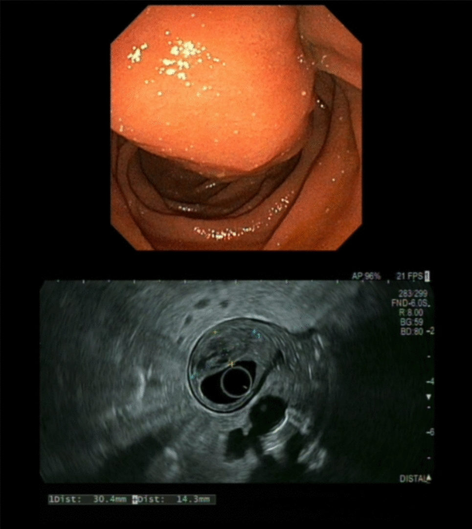 Transduodenal robotic ampullectomy: tips and tricks and strategies for postoperative duodenal fistula management (with video)