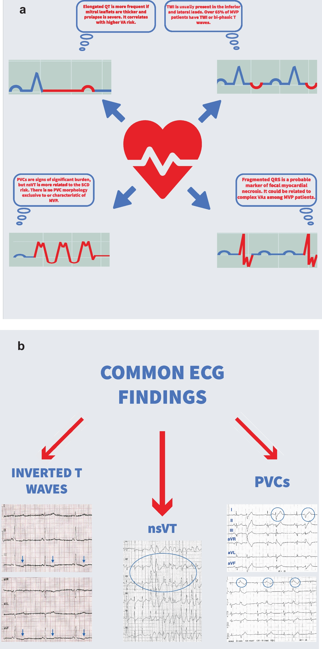 What Do We Know So Far About Ventricular Arrhythmias and Sudden Cardiac Death Prediction in the Mitral Valve Prolapse Population? Could Biomarkers Help Us Predict Their Occurrence?