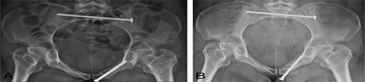 Variables Associated With Loss of Fixation of Retrograde Rami Screws in Minimally Displaced Lateral Compression Type 1 Pelvic Ring Injuries