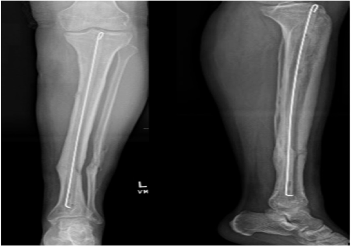 Retention of Antibiotic Cement Delivery Implants in Orthopedic Infection Associated With United Fractures Does Not Increase Recurrence Risk