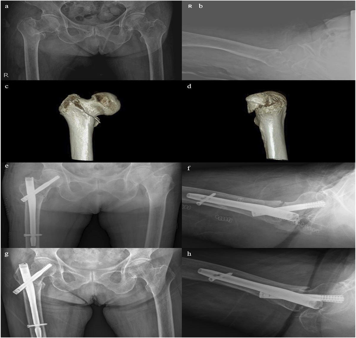 Intramedullary Impaction of the Basicervical Component Is Determinant of Fixation Failure in a Simple Two-Part Pertrochanteric Fracture