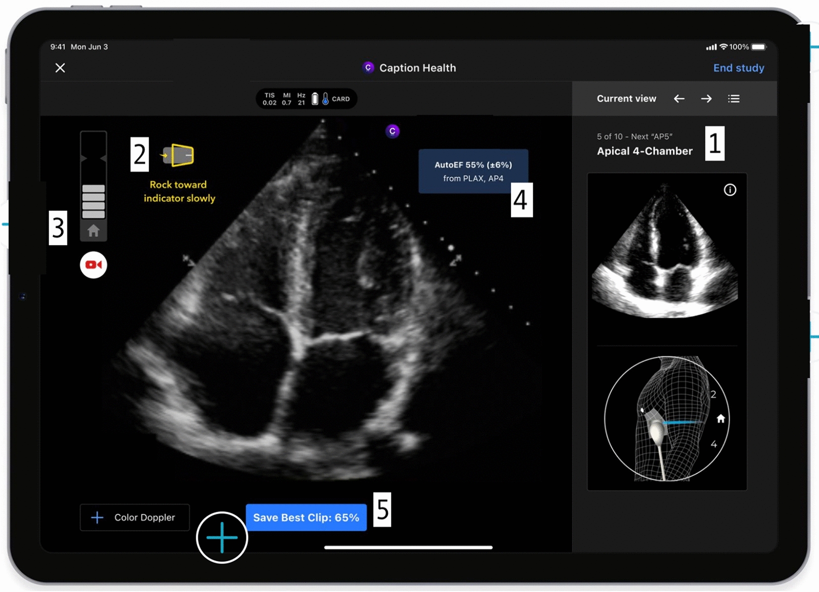 Leveraging the Capabilities of AI: Novice Neurology-Trained Operators Performing Cardiac POCUS in Patients with Acute Brain Injury