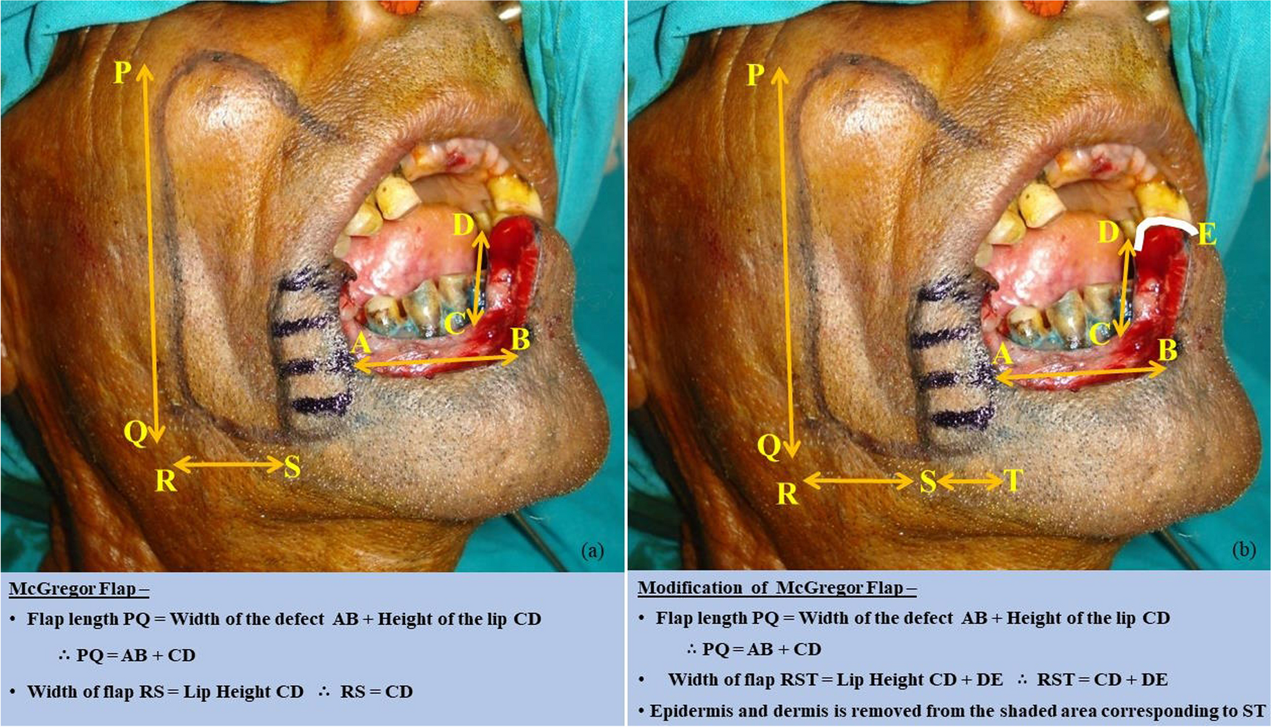 Reconstruction of Full-Thickness Lateral Defect of the Lower Lip and Vermilion with our Modification of a Fan Flap — Technique and Results