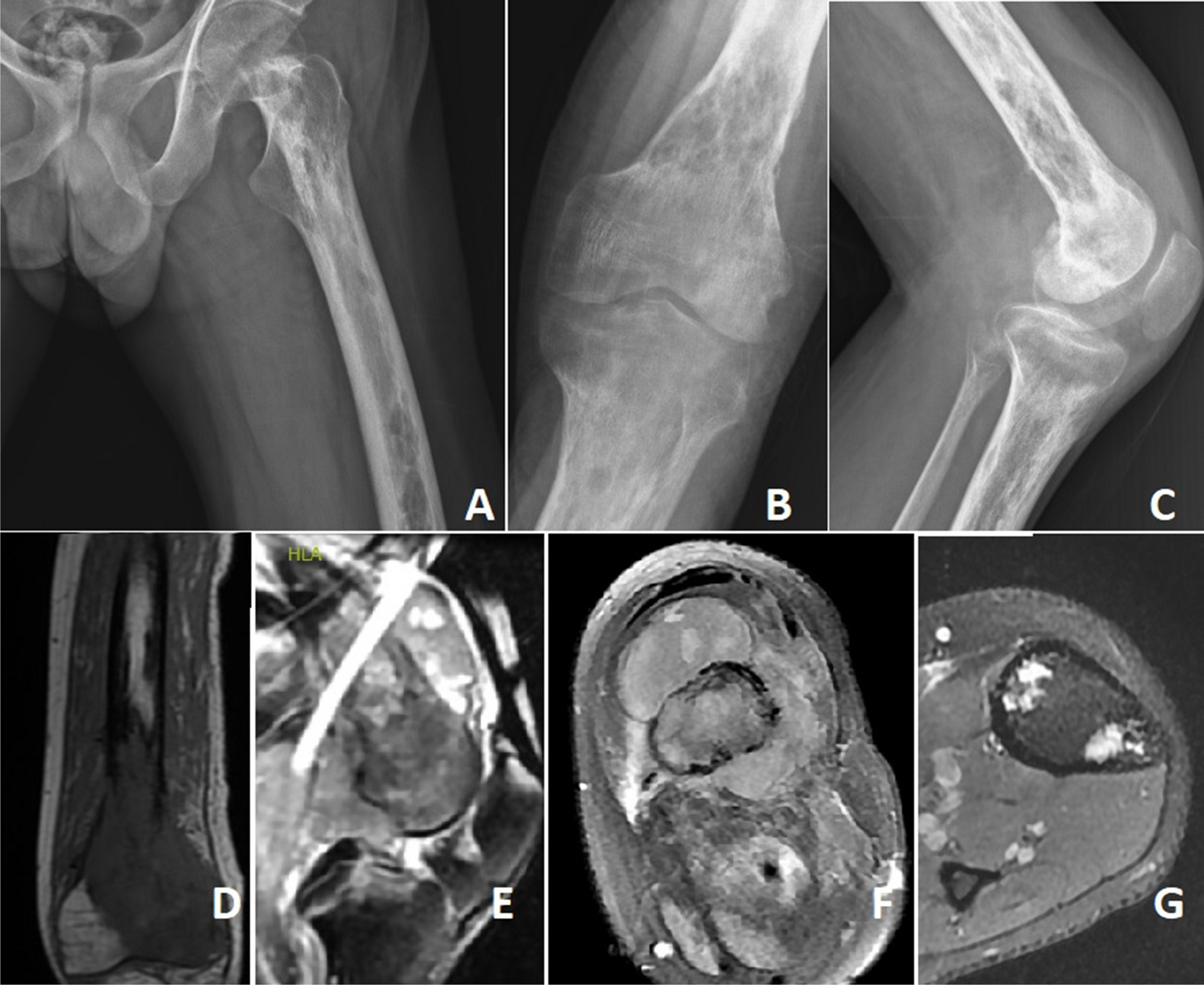 Undifferentiated High-Grade Pleomorphic Bone Sarcoma: A Case Report