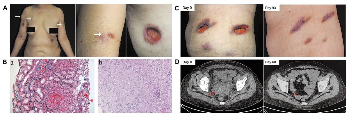 Granulomatosis with polyangiitis presented as multiple cutaneous abscesses after hysterectomy