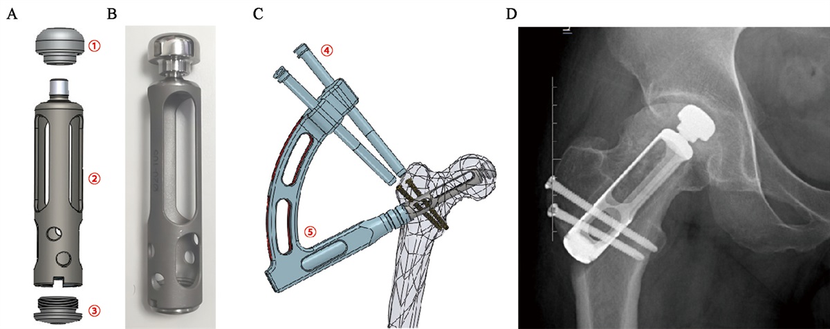 Micro femoral head prosthesis in applications to collapsed femoral head necrosis in the weight-bearing dome (ARCO III): A case series with short-term follow-up