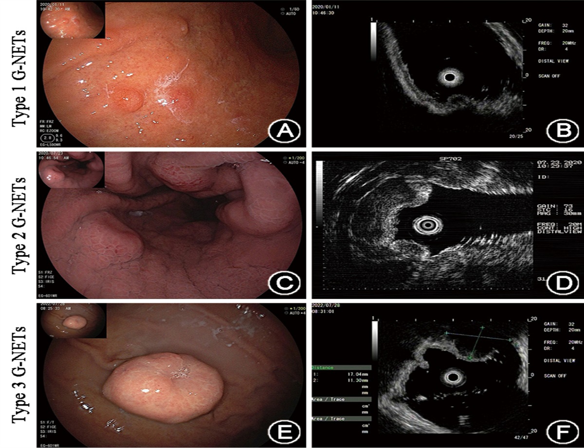 Personalized treatment of well-differentiated gastric neuroendocrine tumors based on clinicopathological classification and grading: A multicenter retrospective study