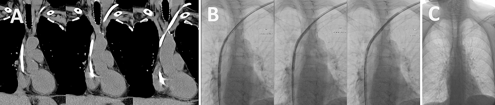 The stuck haemodialysis catheter—a case report of a rare but dreaded complication following kidney transplantation