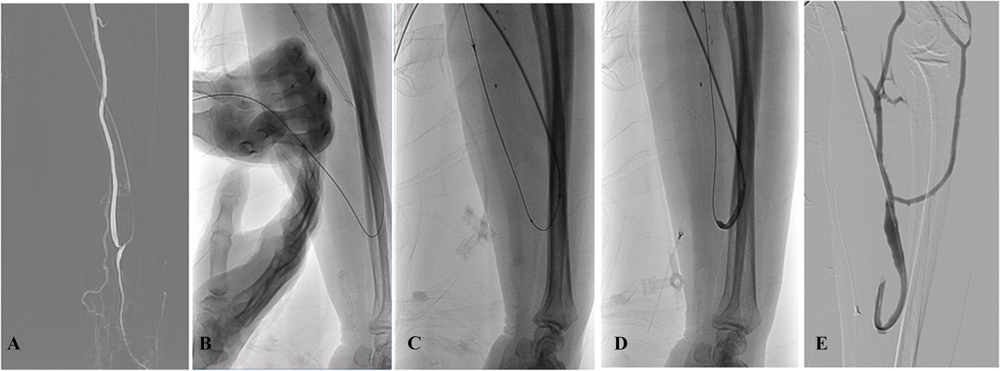 Pull-through technique through antegrade radial artery puncture without sheath insertion in balloon-assisted radiocephalic arteriovenous fistulas maturation