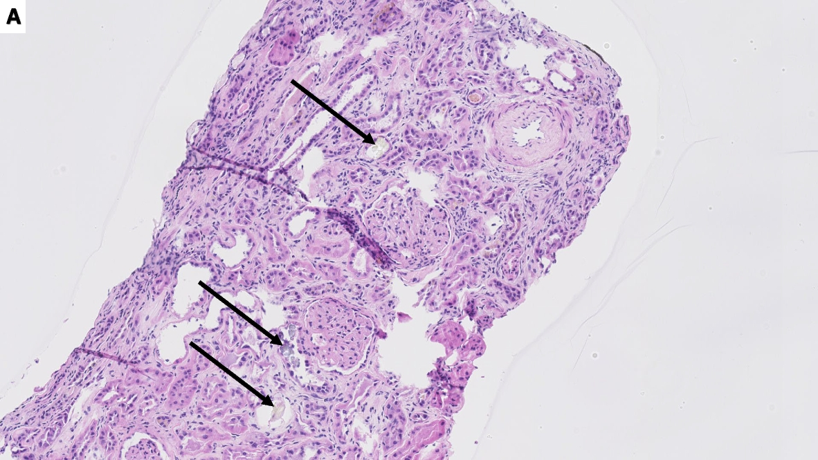 Oxalate nephropathy after pancreaticoduodenectomy: a case report