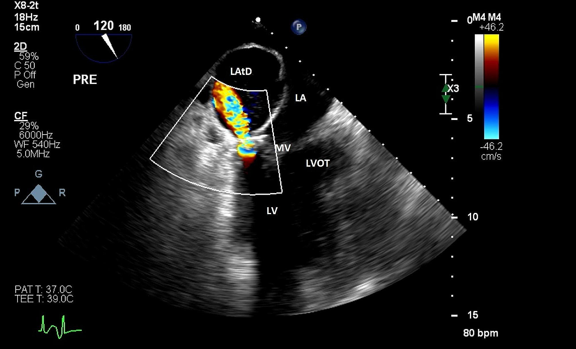 Recognition and management of left atrial dissection during mitral repair