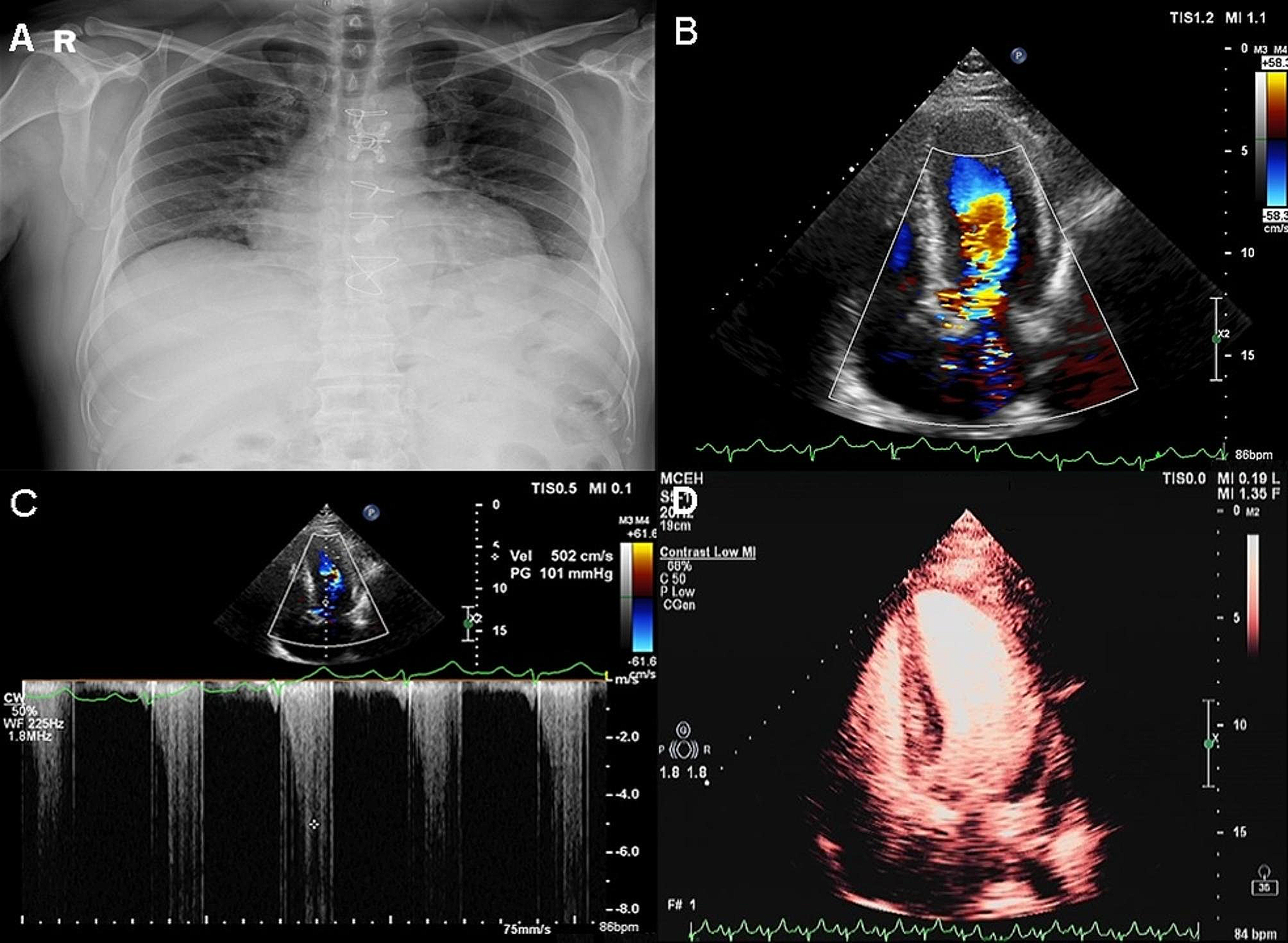 A case of hypertrophic cardiomyopathy with previous aortic valve replacement