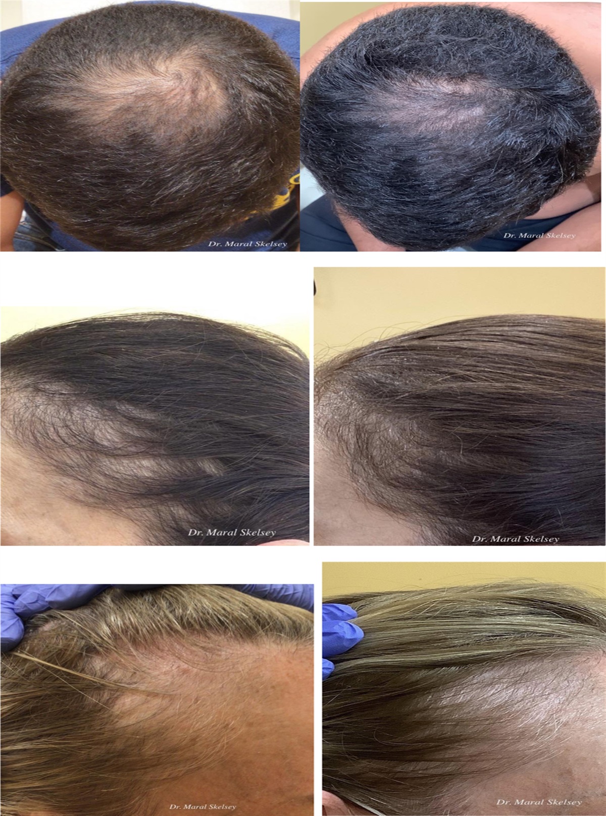 What's Old Is New Again: New and Newly Rediscovered Alopecia Therapies