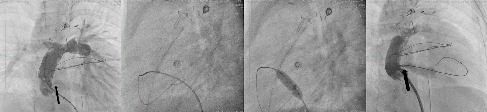 The Lifesaving Impact of Transcatheter Interventions in the Early Post-Fontan Palliation Period