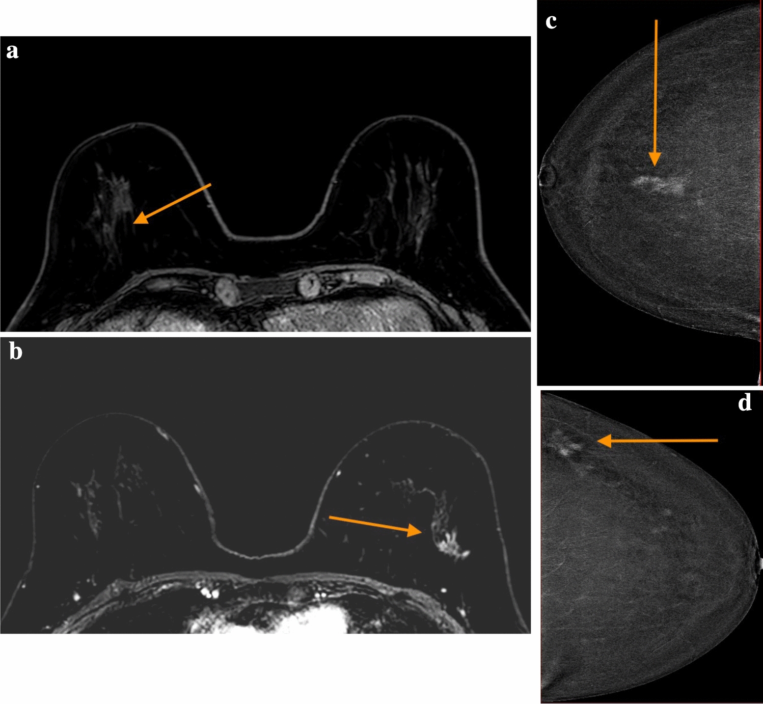 Locoregional staging of breast cancer: contrast-enhanced mammography versus breast magnetic resonance imaging