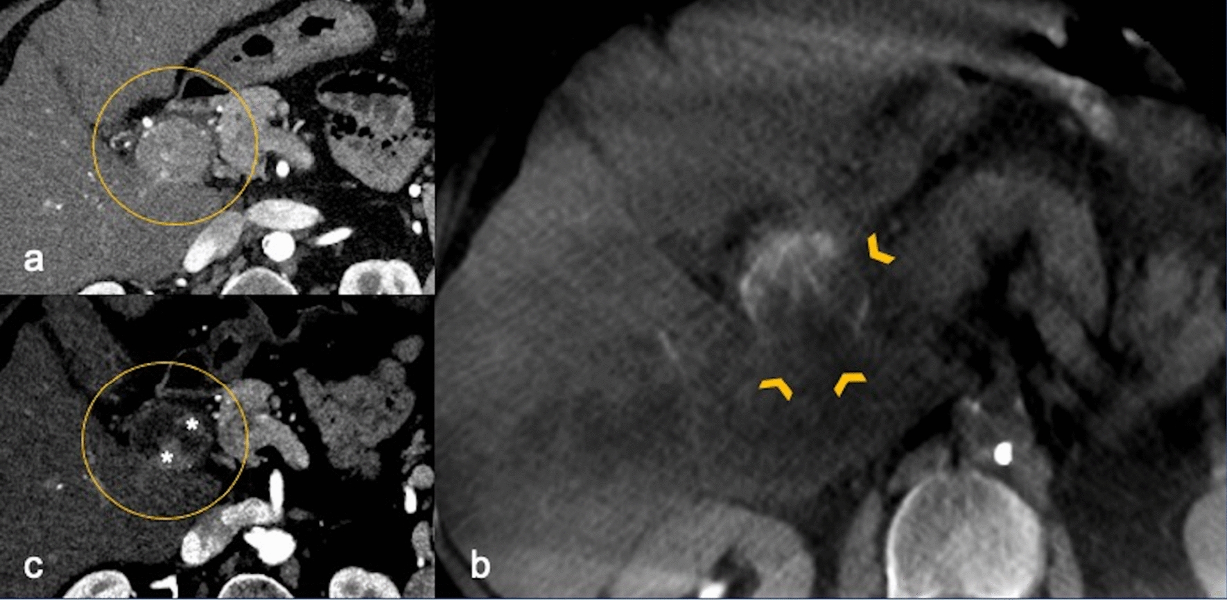 Hug sign in intraprocedural cone-beam-CT to predict short-term response to combined treatment of hepatocellular carcinoma