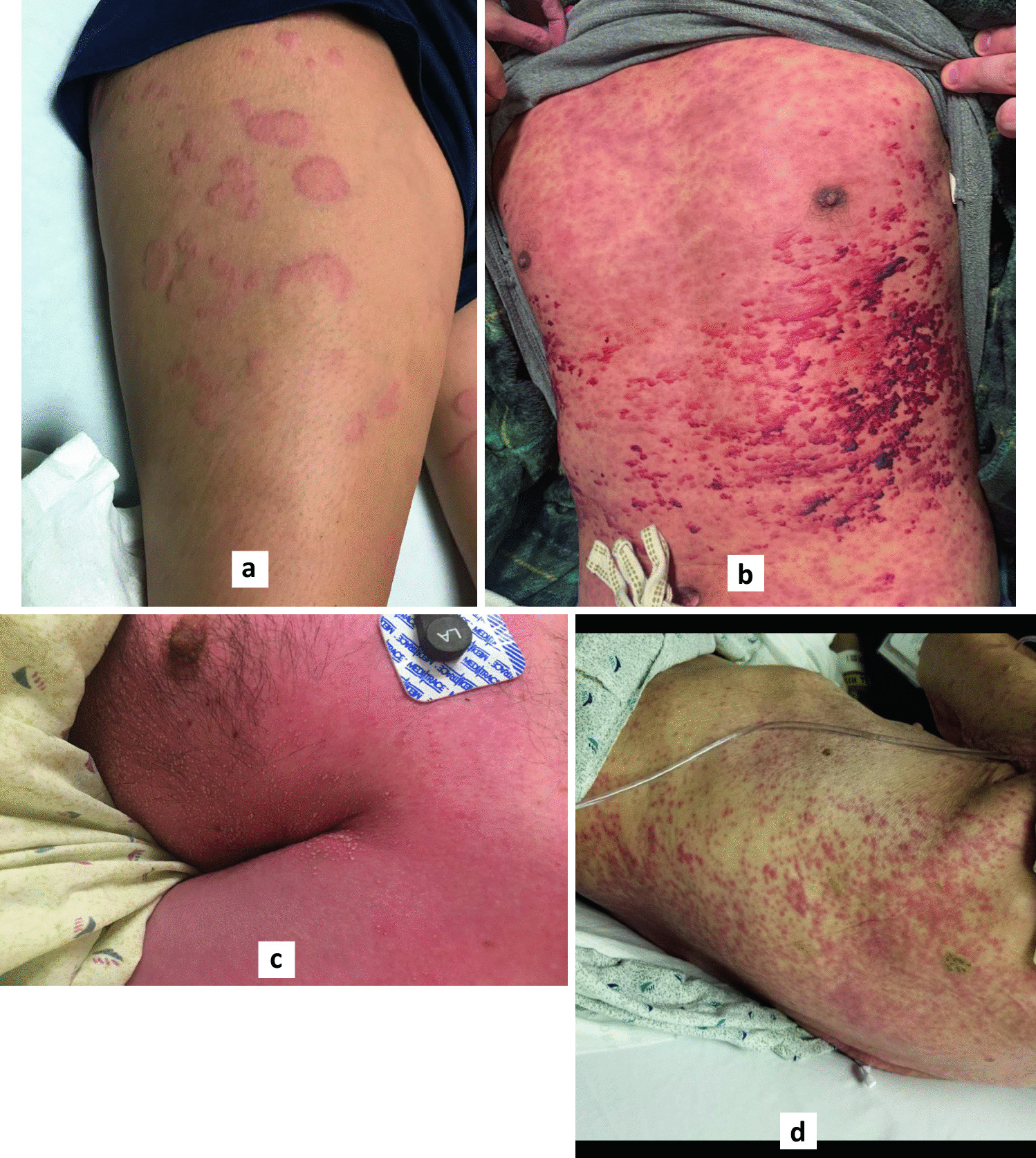 Distinguishing Benign Rashes From Severe Skin Reactions From Anti-Seizure Medications