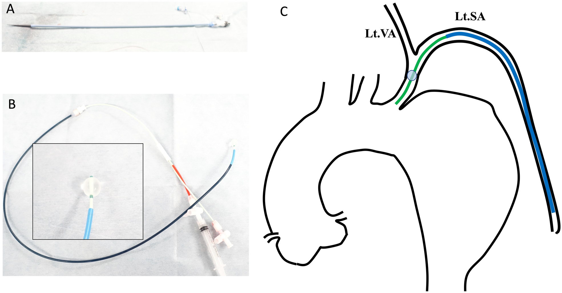 Utilizing a long sheath to minimize atheroma manipulation (minimal manipulation approach) during Zone 1 and 2 thoracic endovascular aortic repair with a shaggy aorta