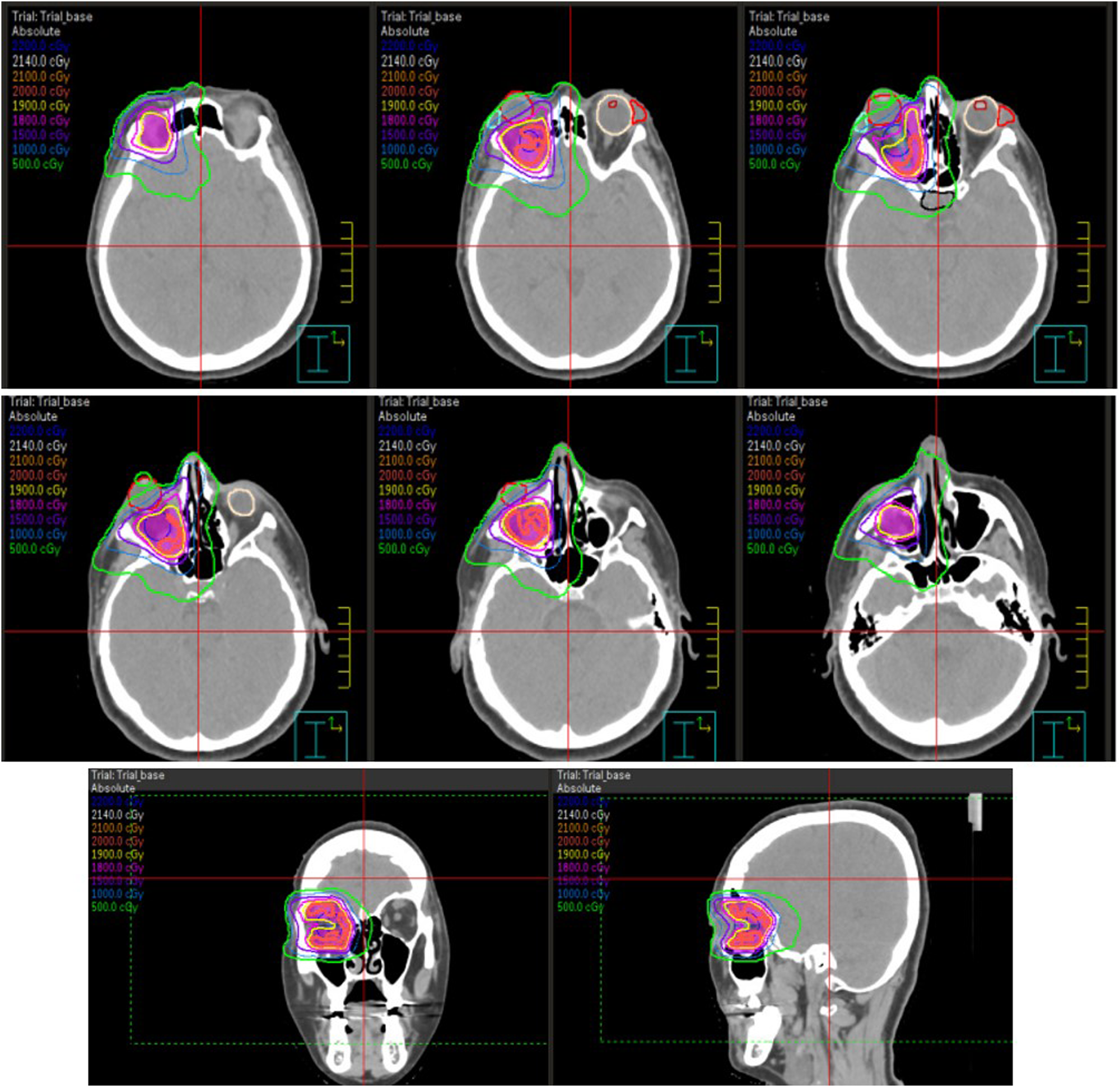Late orbital radiotherapy combined with intravenous methylprednisolone in the management of long-lasting active graves’ orbitopathy: a case report and literature review