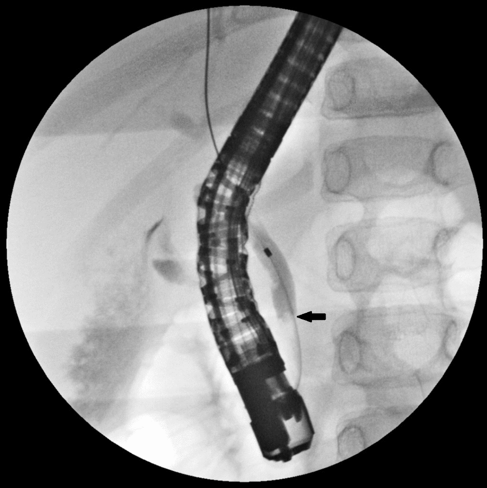 Minimal endoscopic sphincterotomy followed by papillary balloon dilation to relieve choledocholithiasis in a 6-year-old girl with hereditary spherocytosis