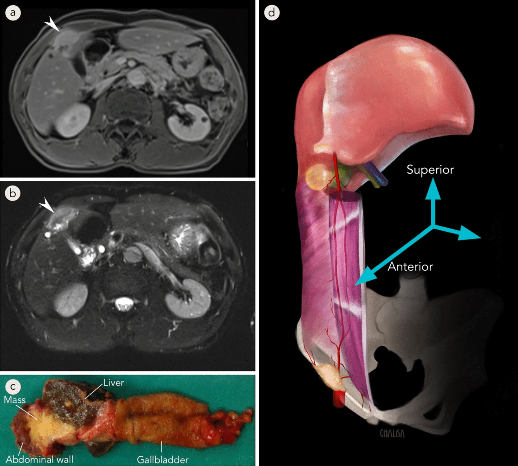 En bloc groin node resection reconstructed with external oblique flap for solitary metastatic cholangiocarcinoma: a case report