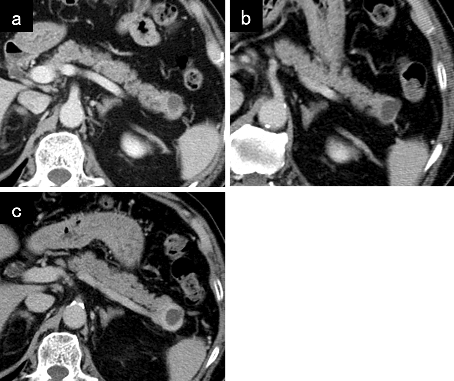 Investigating morphological changes in a simple mucinous cyst during the follow-up period: a case report