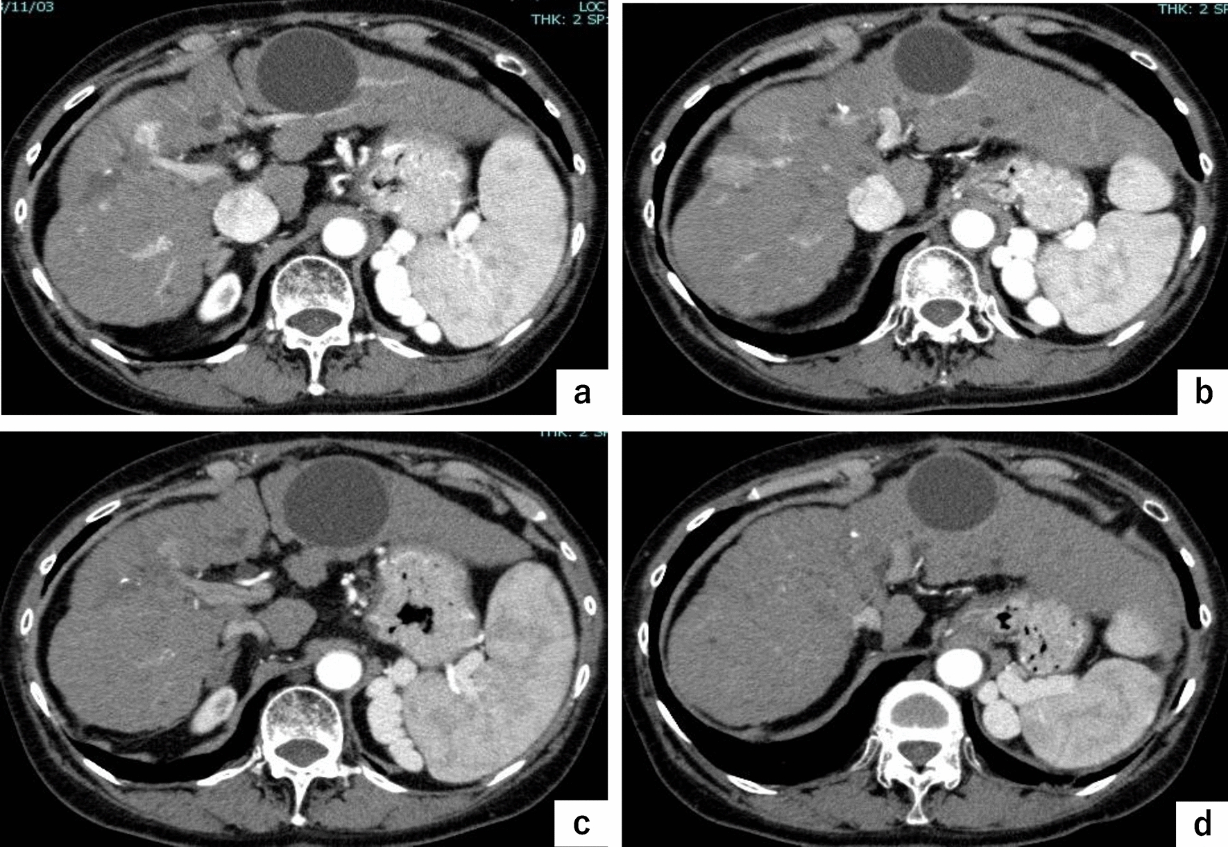 Two cases of severe oral mucositis caused by atezolizumab plus bevacizumab combination therapy for hepatocellular carcinoma
