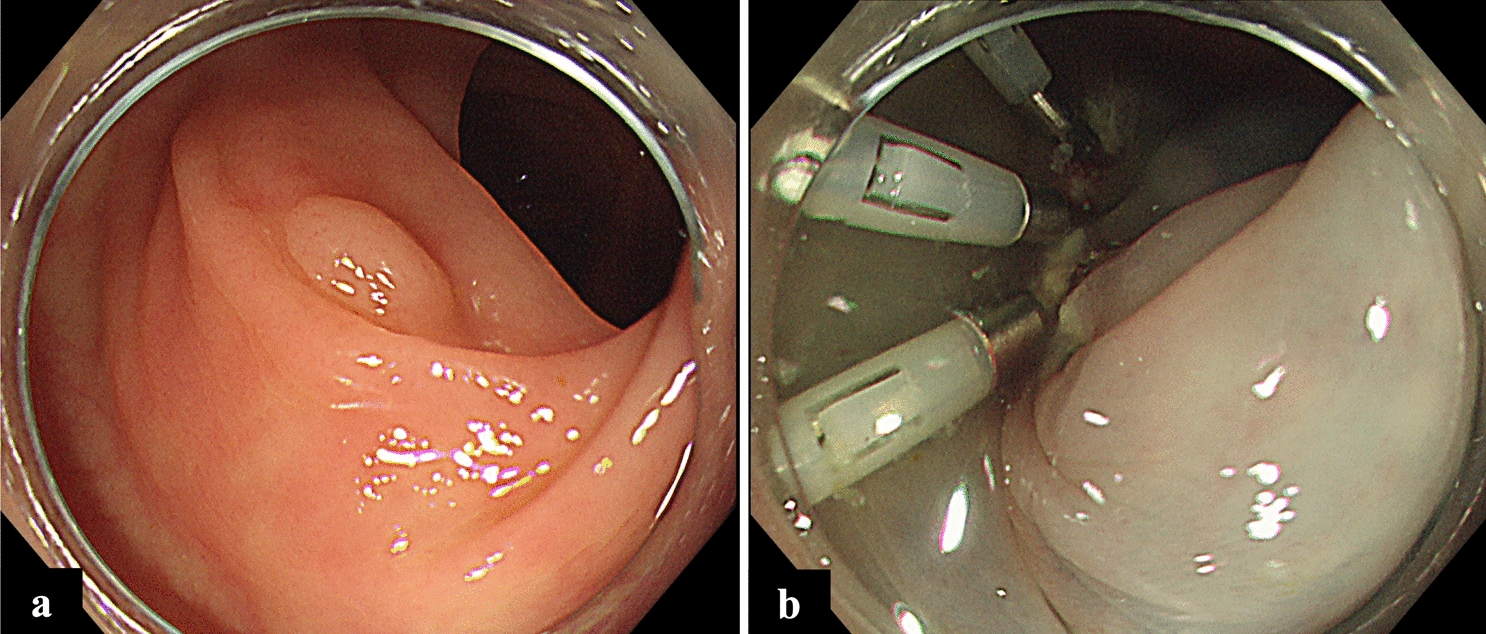 Colonic intussusception after endoscopic mucosal resection successfully managed by endoscopic procedure