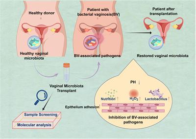 Vaginal microbiota transplantation is a truly opulent and promising edge: fully grasp its potential