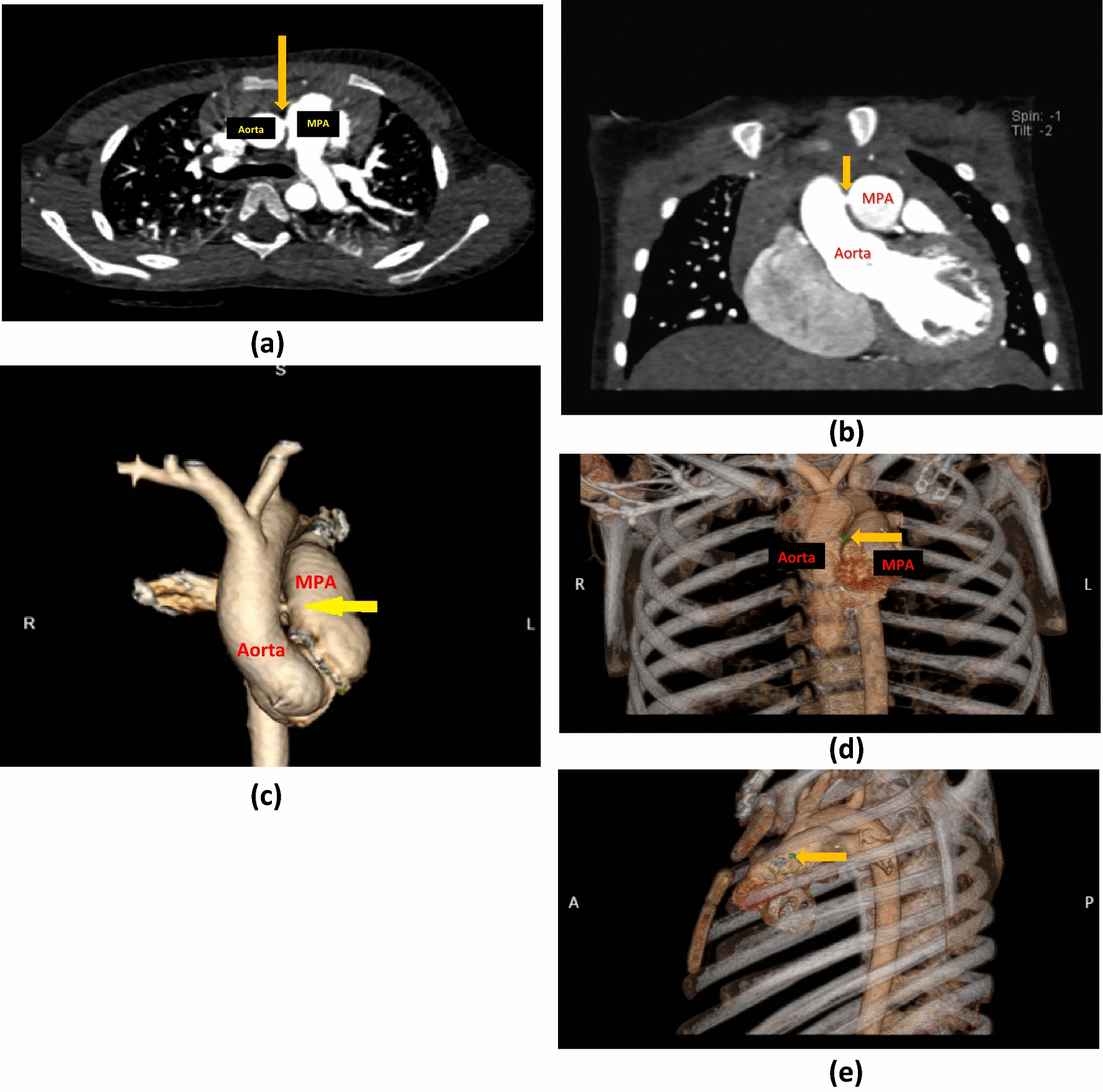 3D Echocardiographic and Computed Tomographic Angiography Guidance for Percutaneous Closure of a Type II (Intermediate) Aortopulmonary Window