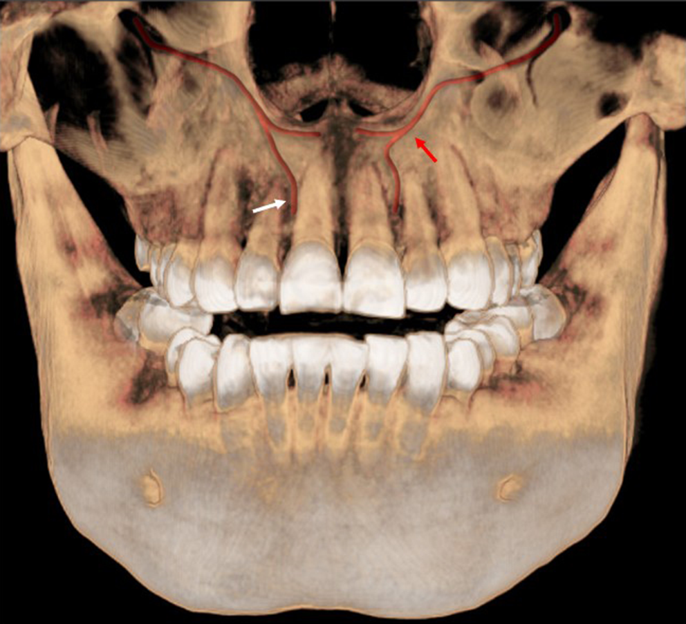 Cone-beam computed tomography of accessory canals of the canalis sinuosus and analysis of the related risk factors