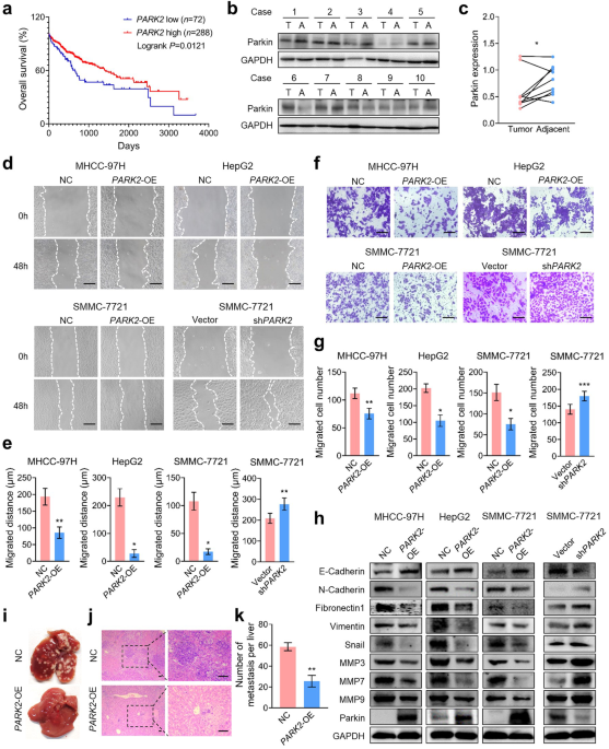 Parkin deficiency promotes liver cancer metastasis by TMEFF1 transcription activation via TGF-β/Smad2/3 pathway