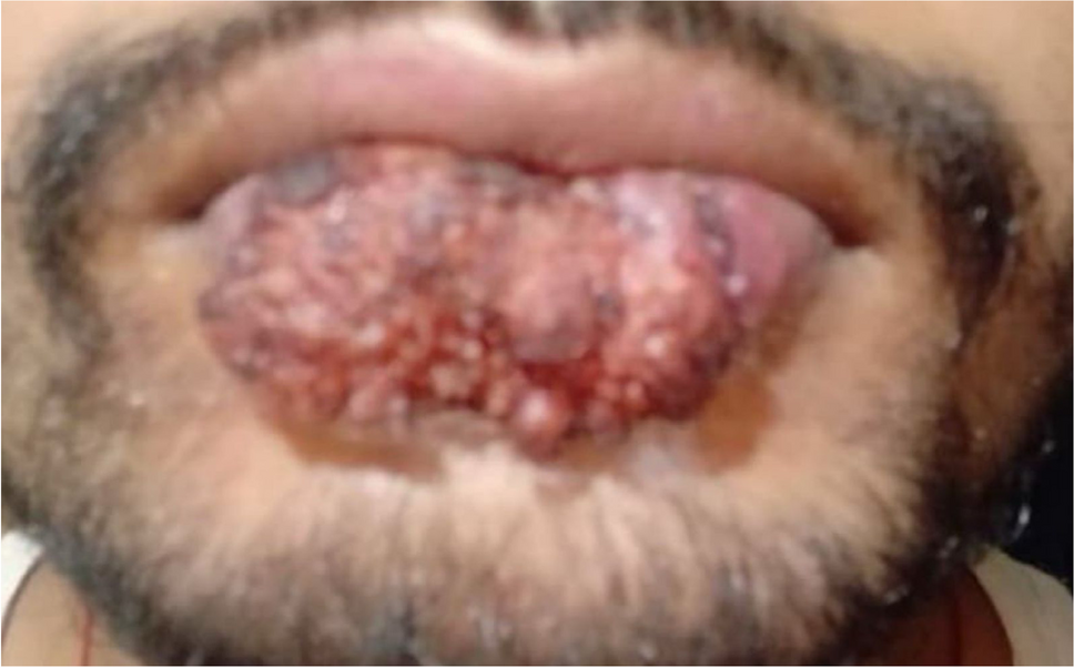 Unusual Presentation of Squamous Cell Carcinoma in a Young Male: Clinicopathological Insights and Considerations