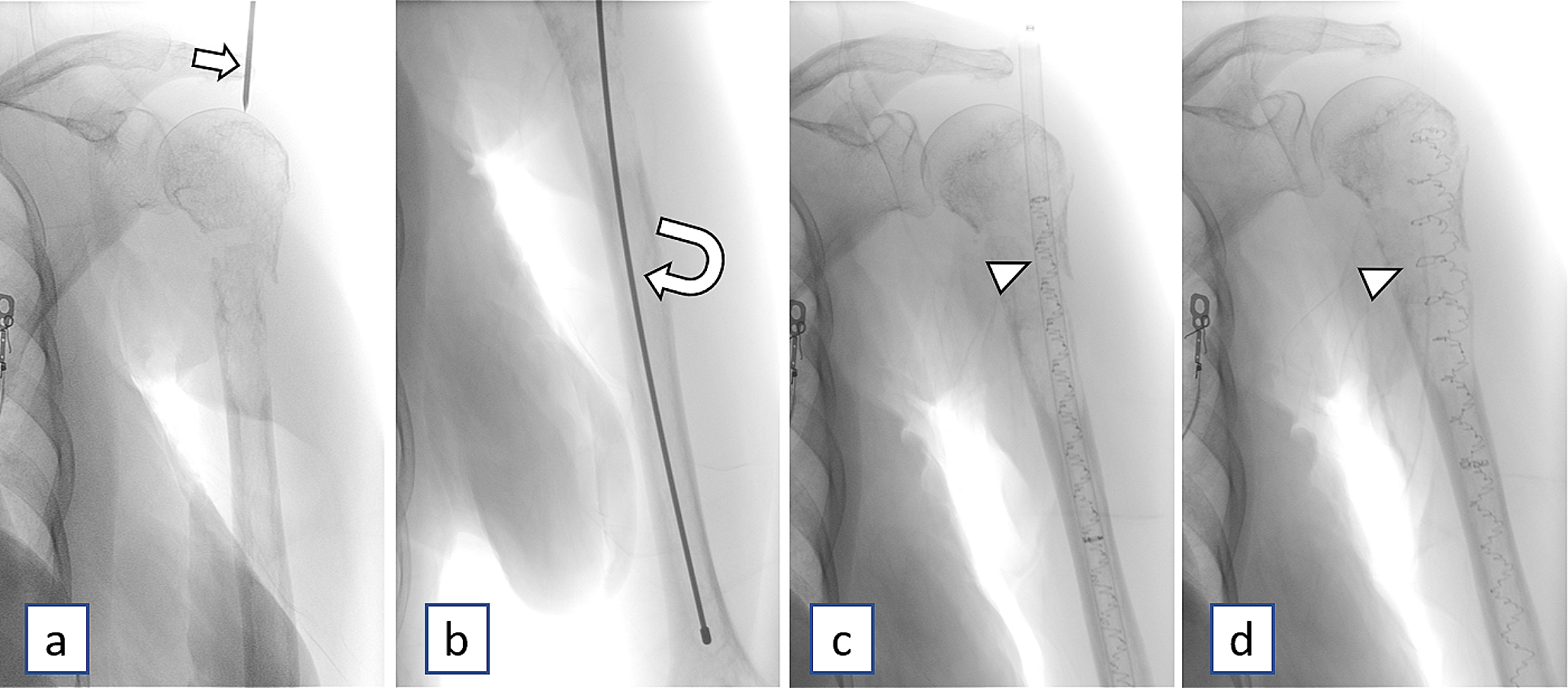 Novel illuminoss photodynamic bone stabilization system: normal and post-operative complication imaging findings in the emergency setting